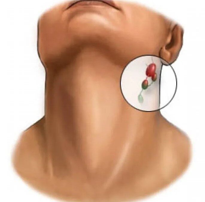 Λεμφαδενοπάθεια