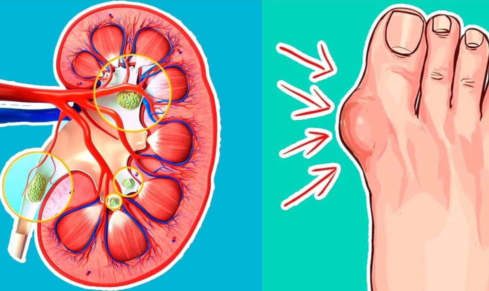 Νόσος ουρικού οξέος